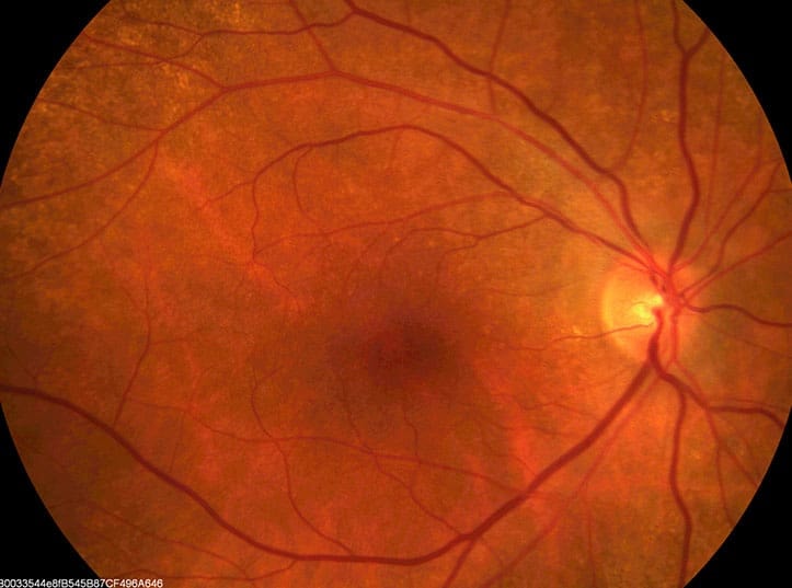 Close-up image of a human retina showing blood vessels and optic nerve head.