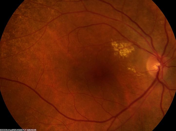 Retinal image showing changes consistent with age-related macular degeneration.