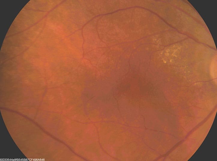 Close-up image of a human retina with blood vessels and optic disc visible.