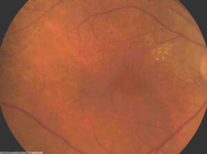 Retinal scan 2