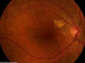 Retinal scan 1